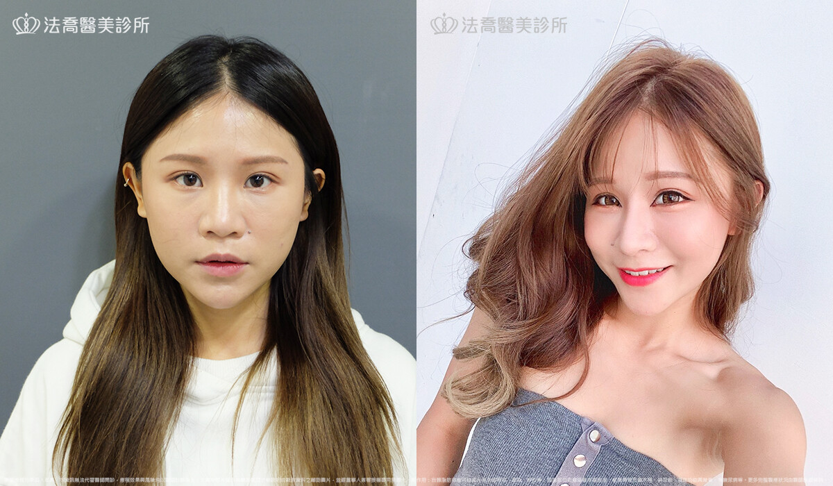 法喬醫美診所,邱浚彥,自體肋骨隆鼻