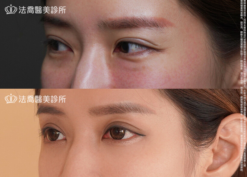 眼袋內開、脂肪移位 術前與術後3個月