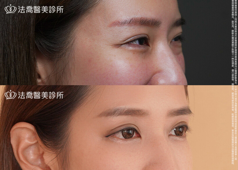 眼袋內開、脂肪移位 術前與術後3個月
