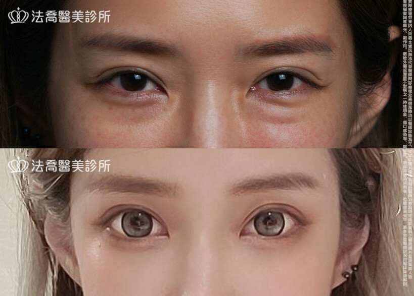 眼袋內開、脂肪移位 術前與術後1個月