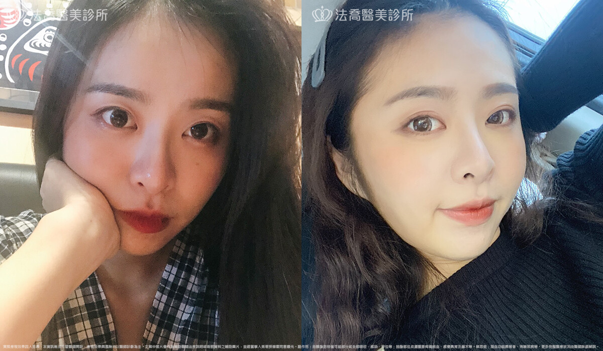法喬醫美診所,邱浚彥,割雙眼皮