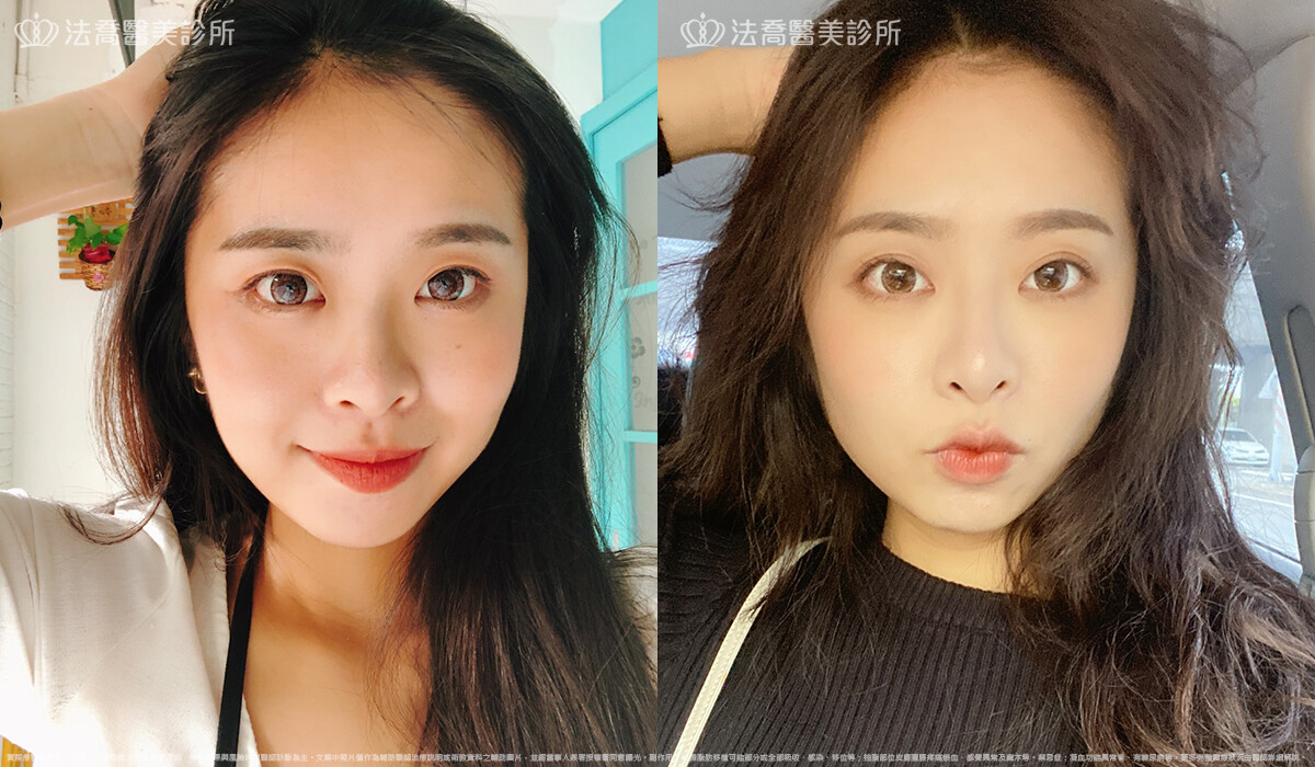 法喬醫美診所,邱浚彥,割雙眼皮