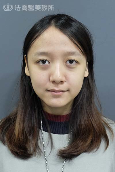 自體肋骨隆鼻