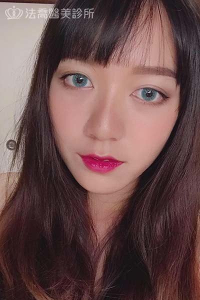 自體肋骨隆鼻