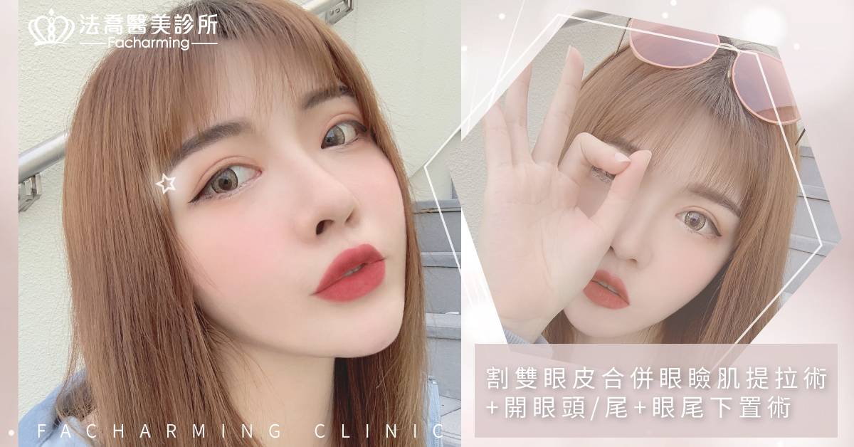 雙眼皮