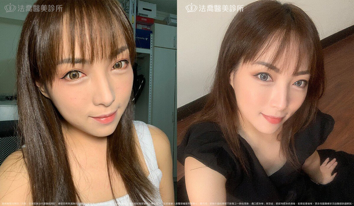 眼袋內開 脂肪移位  術後1個月