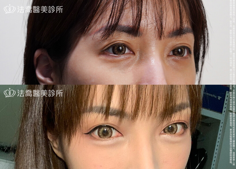 眼袋內開、脂肪移位 &nbsp;術前與術後1個月