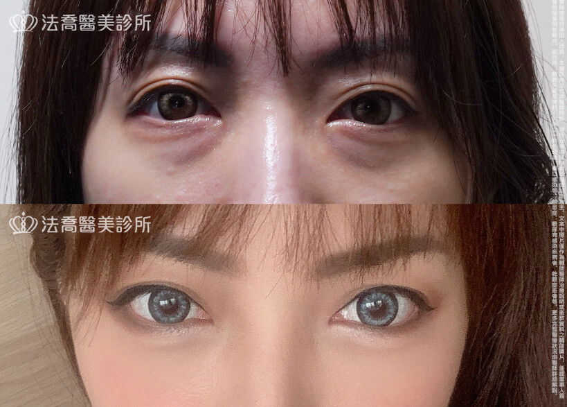眼袋內開、脂肪移位  術前與術後1個月