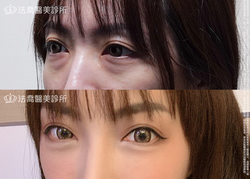眼袋內開、脂肪移位 &nbsp;術前與術後1個月
