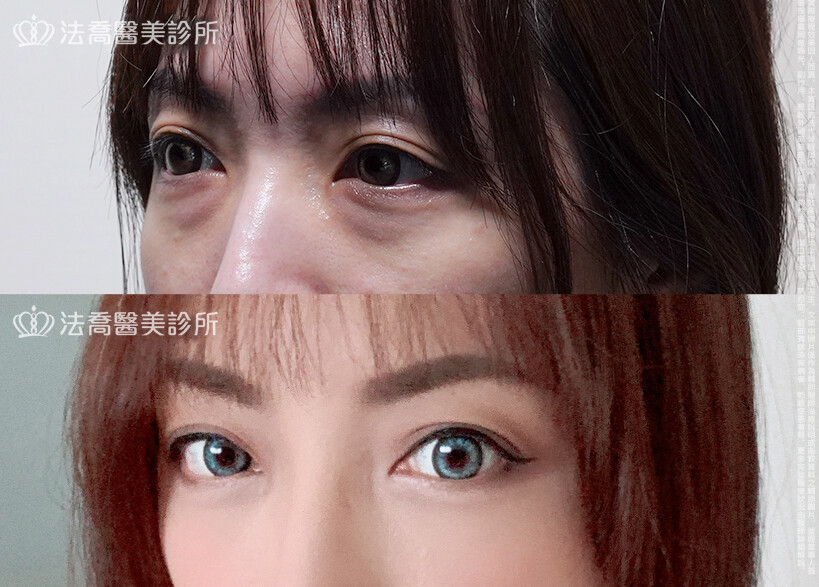 眼袋內開、脂肪移位 &nbsp;術前與術後3個月