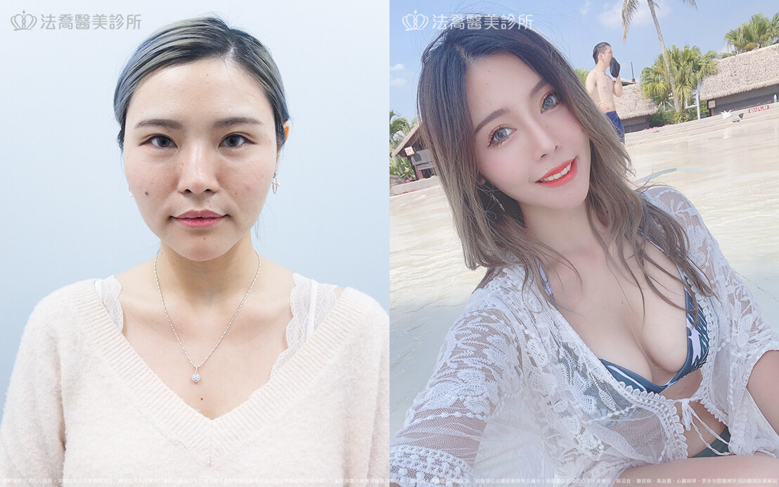 雙眼皮手術費用