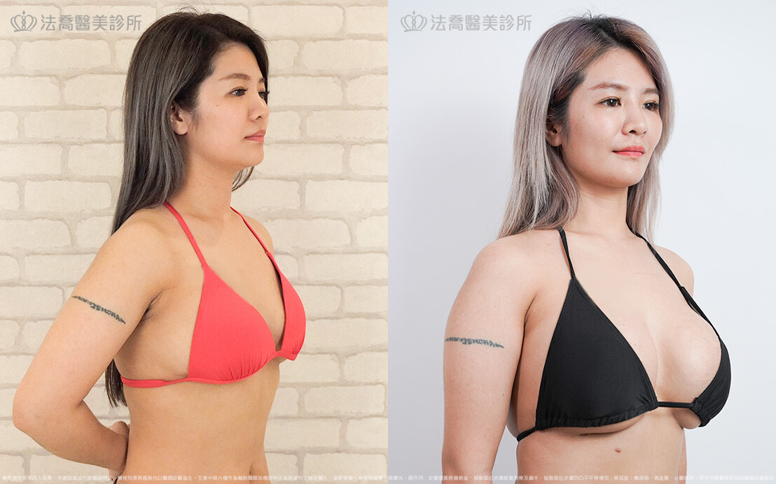 法喬醫美診所,邱浚彥,超音波複合式隆乳