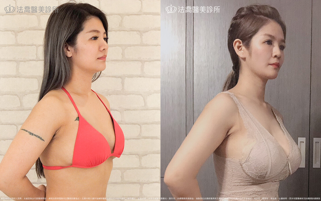 法喬醫美診所,邱浚彥,超音波複合式隆乳