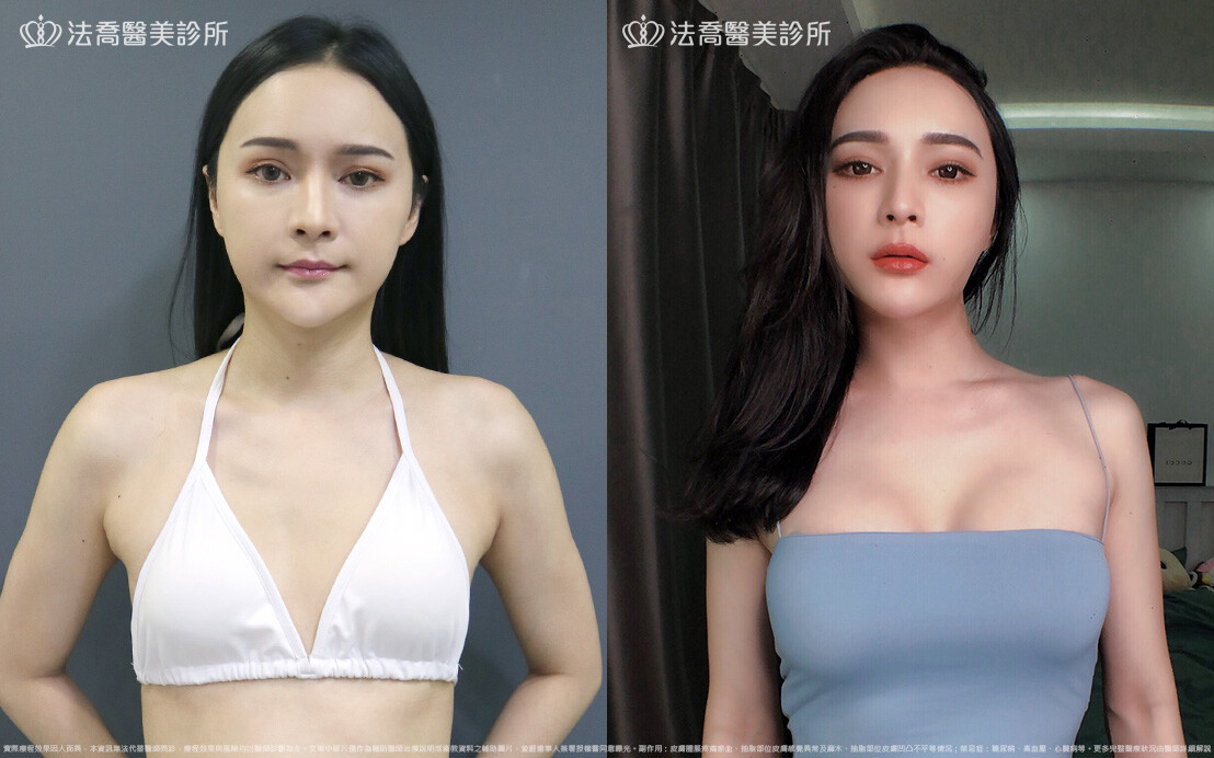 隆乳合併自體脂肪豐胸