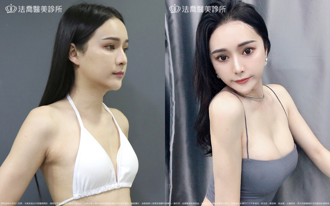 隆乳合併自體脂肪豐胸