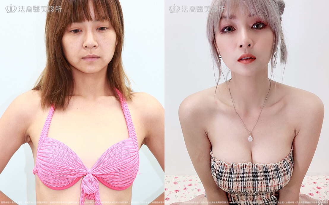 隆乳合併自體脂肪豐胸 超音波刀水滴果凍矽膠隆乳 自體脂肪豐胸 隆乳手術