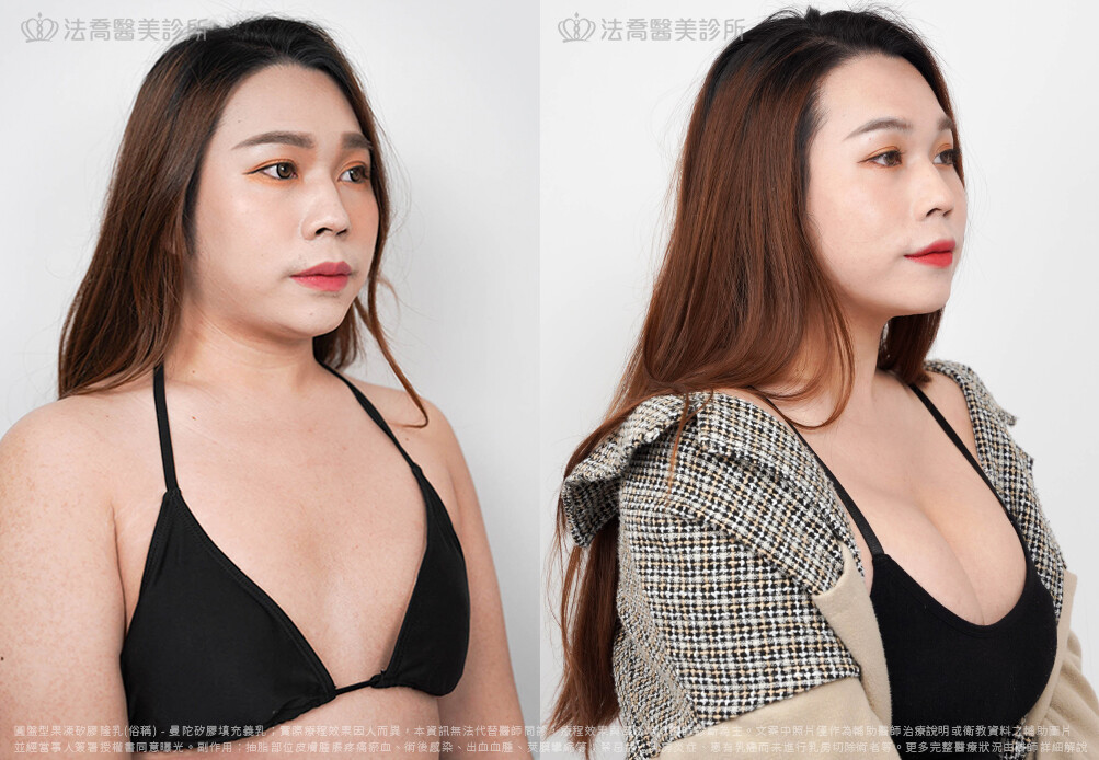 兔兔隆乳術後6個月C