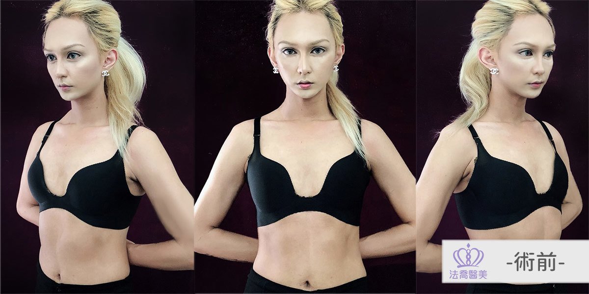 法喬醫美診所複合式隆乳