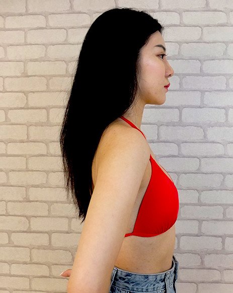 法喬醫美診所_圓盤隆乳術前照