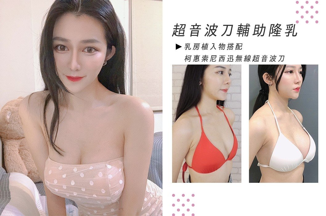 法喬醫美診所《楊冪》圓盤果凍矽膠隆乳 X 超音波刀(俗稱超聲刀) 魔滴隆乳推薦