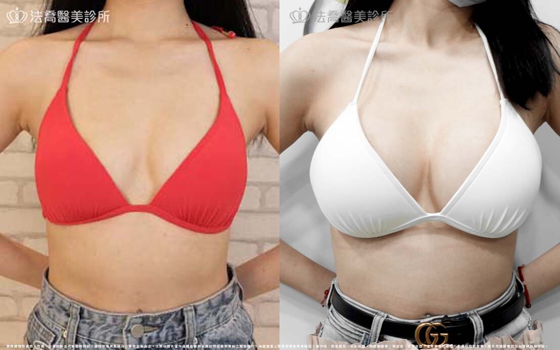 圓盤果凍矽膠隆乳、自體脂肪豐胸 / 術前與術後一年