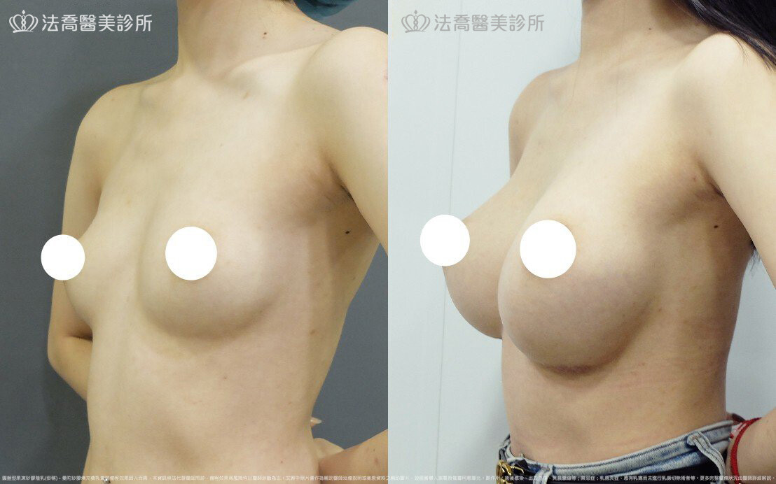 圓盤果凍矽膠隆乳、自體脂肪豐胸 / 術前與術後一年