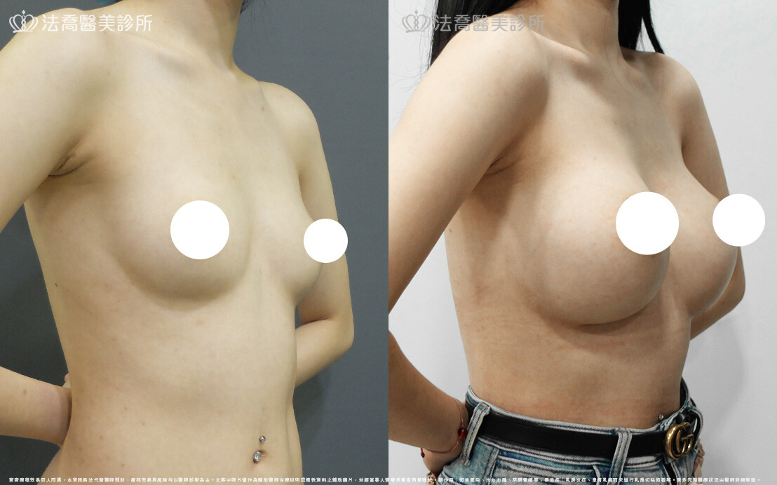 圓盤果凍矽膠隆乳、自體脂肪豐胸 / 術前與術後一年