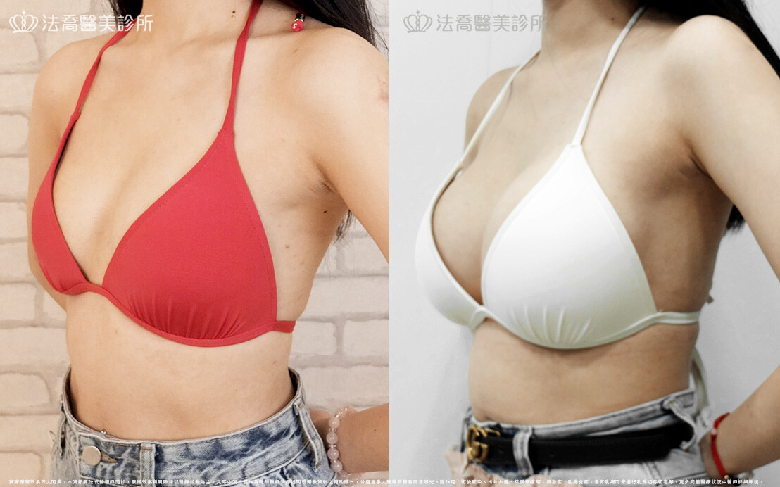 圓盤果凍矽膠隆乳、自體脂肪豐胸 / 術前與術後一年
