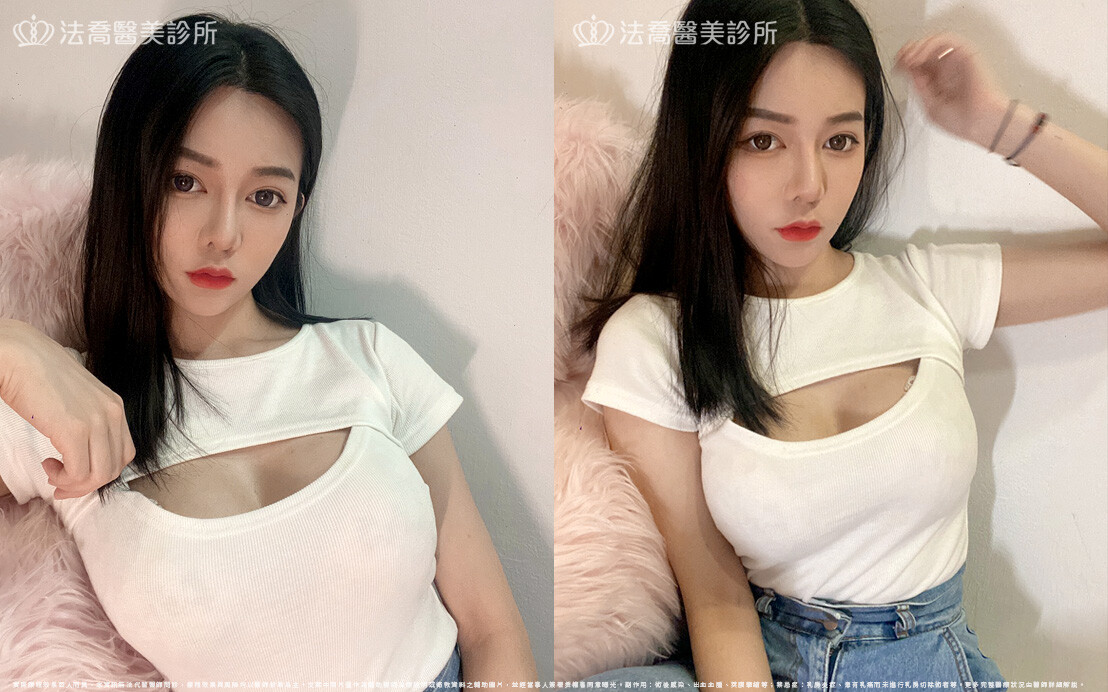 圓盤果凍矽膠隆乳、自體脂肪豐胸 / 術後一年六個月生活照