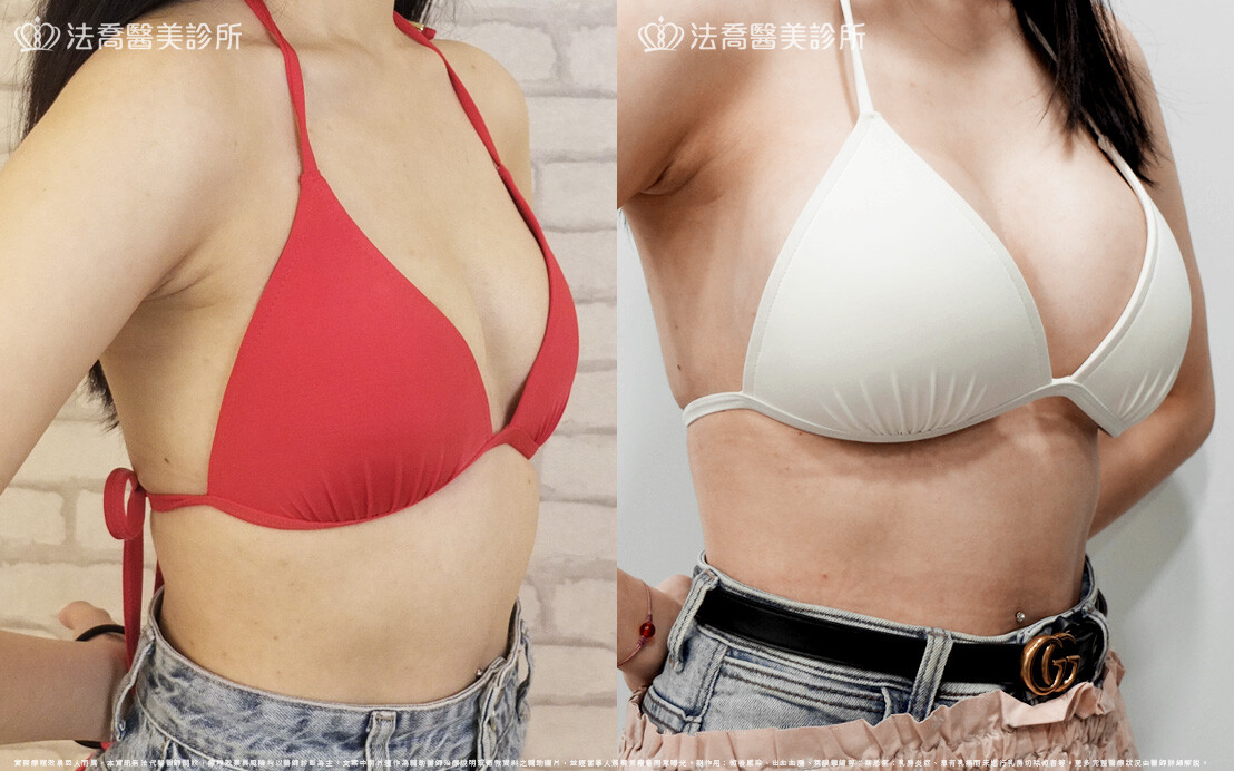圓盤果凍矽膠隆乳、自體脂肪豐胸 / 術前與術後一年