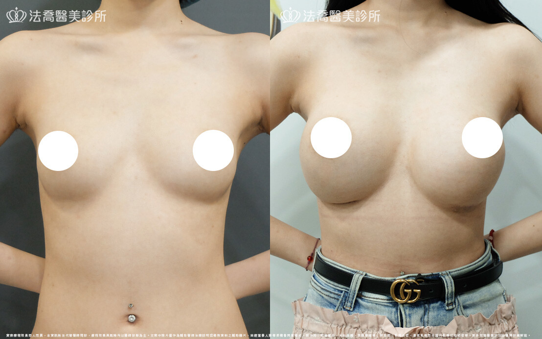 圓盤果凍矽膠隆乳、自體脂肪豐胸 / 術前與術後一年