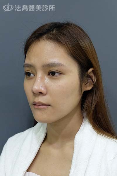 自體肋骨隆鼻
