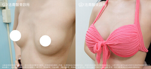 水滴型隆乳