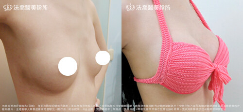 隆乳推薦