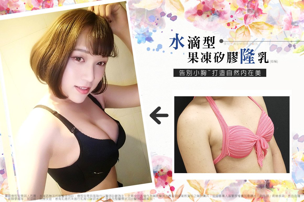 法喬隆乳專家案例照