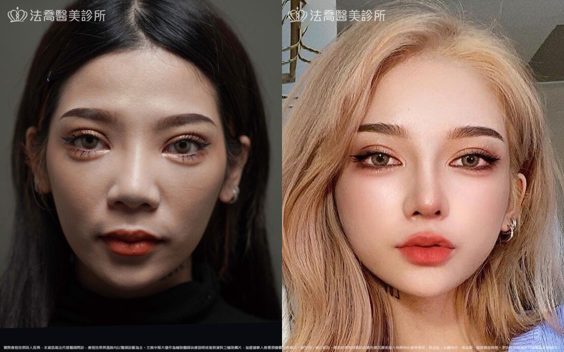 術前與術後7個月