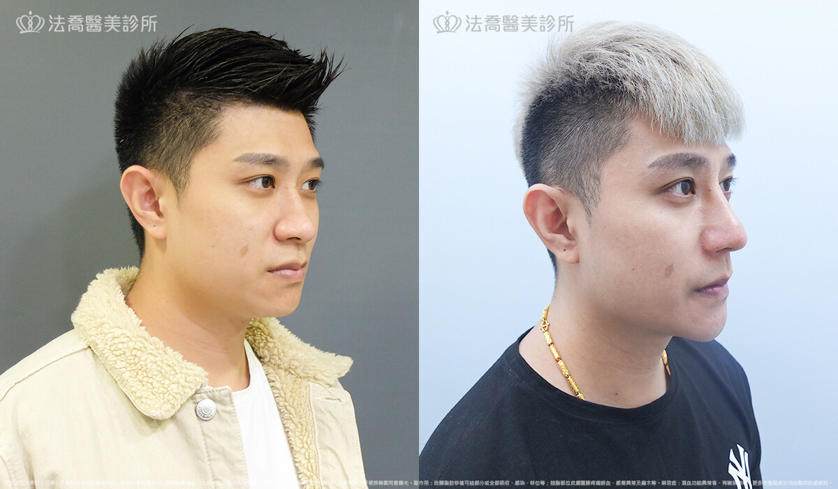 法喬醫美診所,邱浚彥,自體肋骨隆鼻