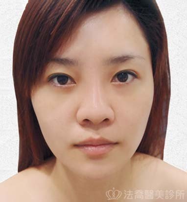 法喬醫美診所_自體肋骨隆鼻術前