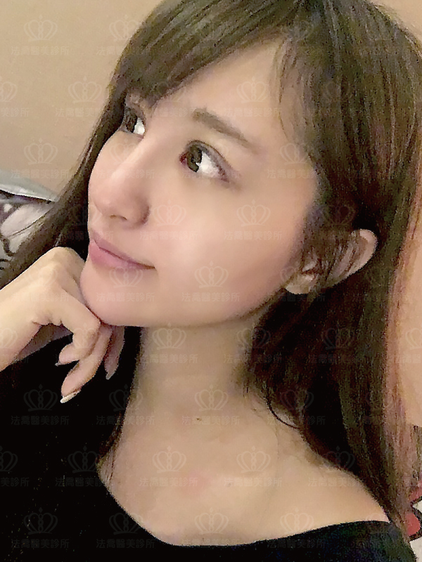 法喬醫美診所自體肋骨隆鼻術後15天BA圖
