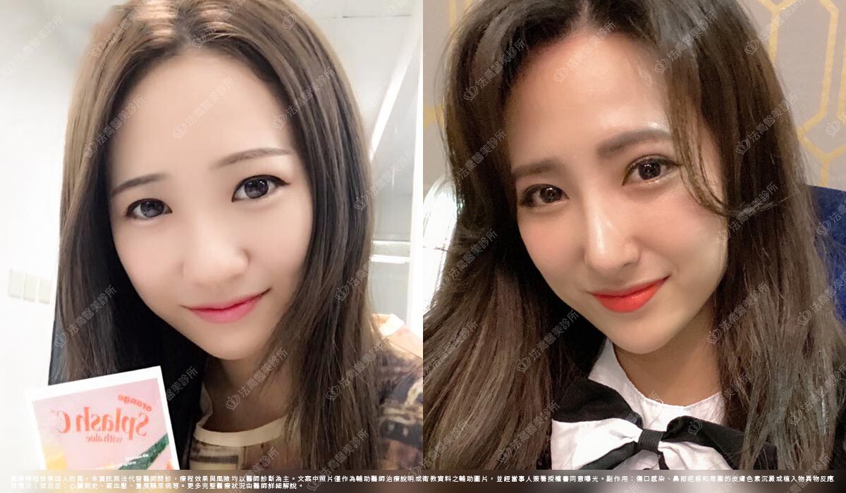 自體肋骨隆鼻,法喬醫美診所,邱浚彥