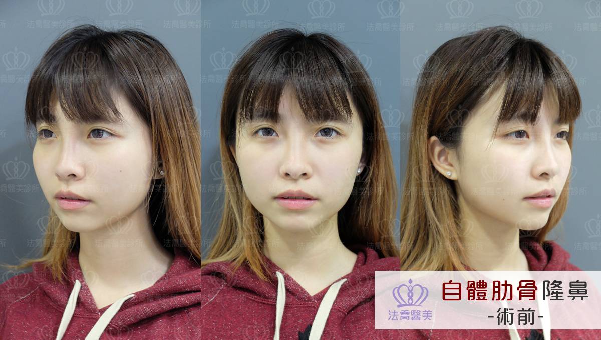 自體肋骨隆鼻