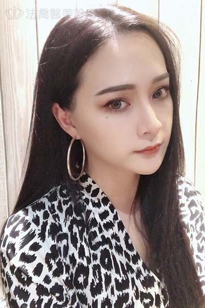 自體肋骨隆鼻
