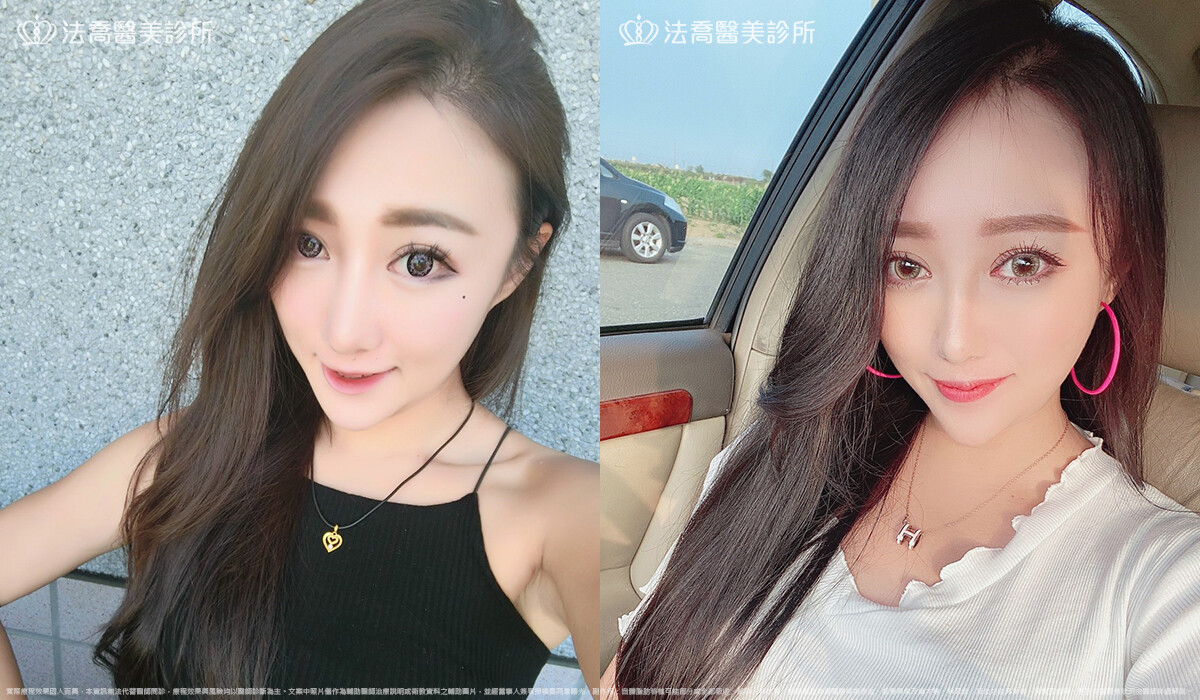 法喬醫美診所,邱浚彥,自體肋骨隆鼻