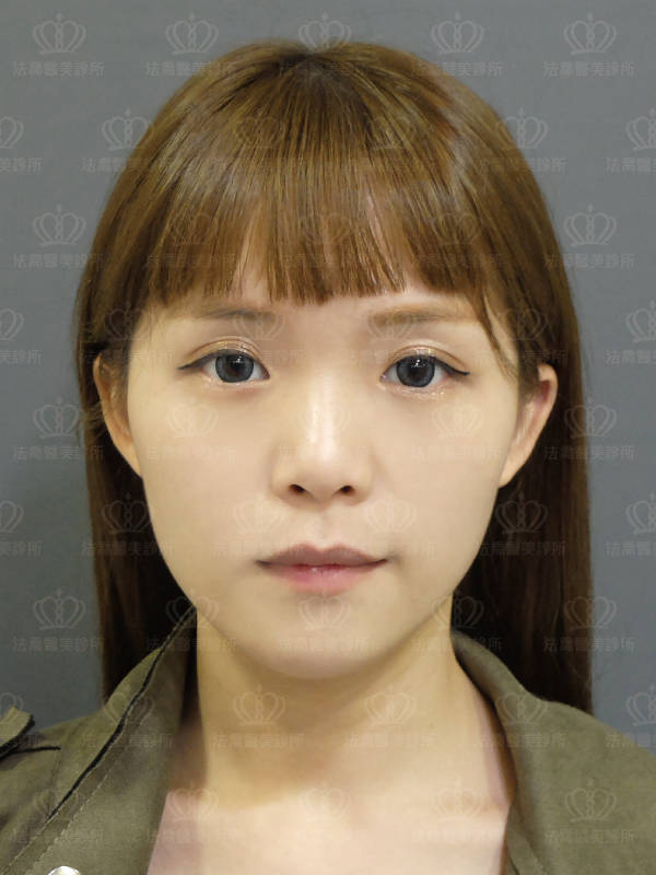 自體肋骨隆鼻