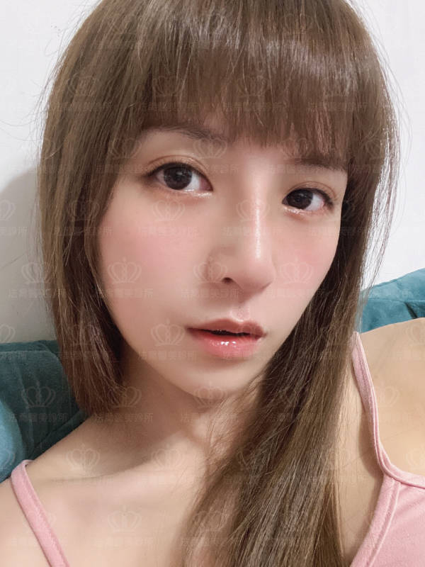 自體肋骨隆鼻