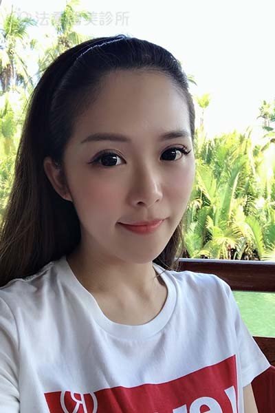 自體肋骨隆鼻