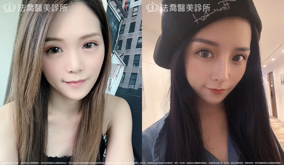 法喬醫美診所,邱浚彥,自體肋骨隆鼻