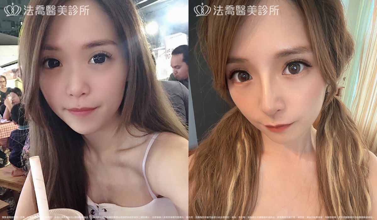 法喬醫美診所,邱浚彥,自體肋骨隆鼻
