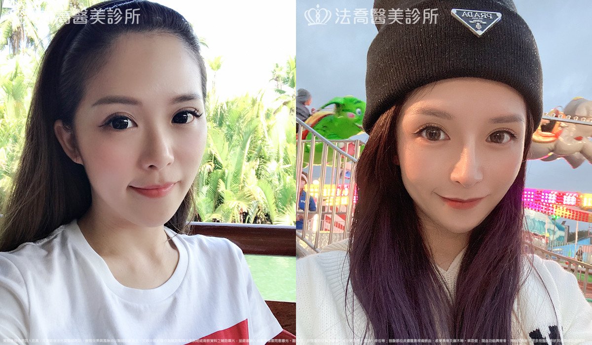 法喬醫美診所,邱浚彥,自體肋骨隆鼻