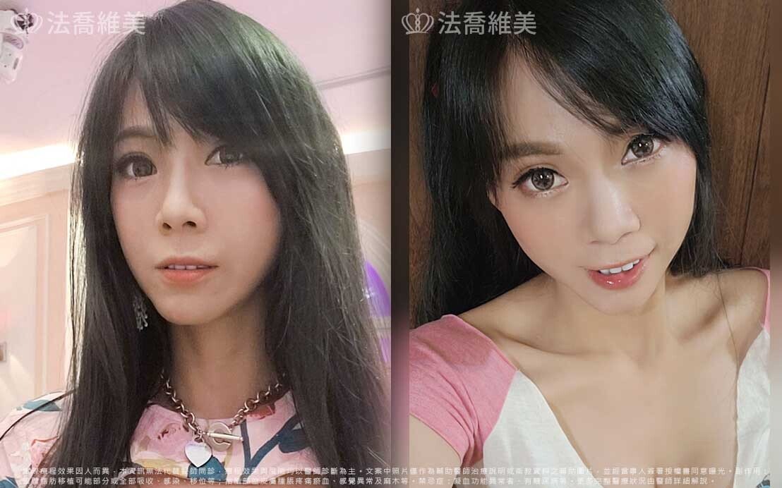 豐臉